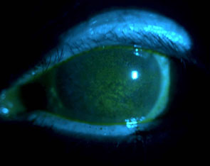 Severe Punctate Corneal Dessication Staining